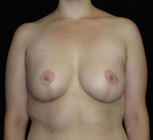 Breast Augmentation Patient Photo - Case 111 - after view