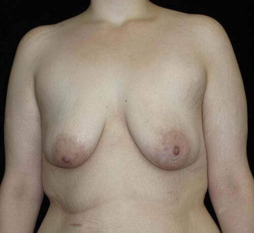 Breast Augmentation Patient Photo - Case 111 - before view-