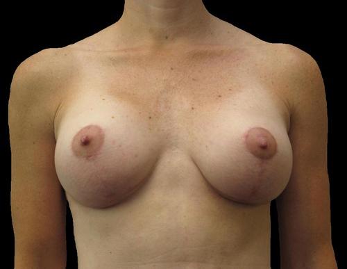 Breast Augmentation Patient Photo - Case 93 - after view-0