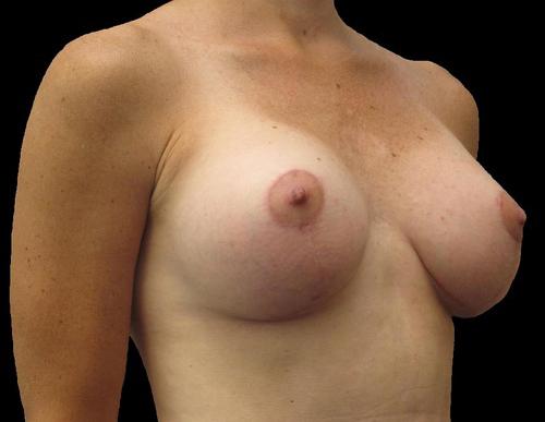 Breast Augmentation Patient Photo - Case 93 - after view-1