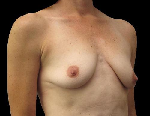 Breast Augmentation Patient Photo - Case 93 - before view-1