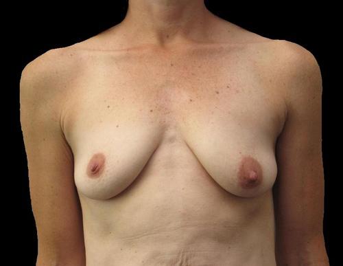 Breast Augmentation Patient Photo - Case 93 - before view-0