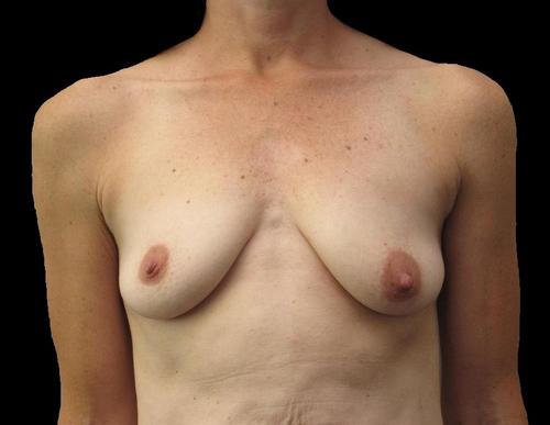 Breast Augmentation Patient Photo - Case 93 - before view-