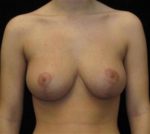 Breast Lift - Case 96 - After