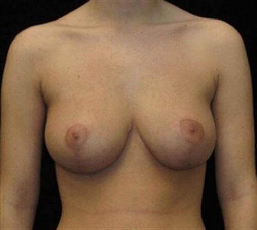 Breast Lift Patient Photo - Case 96 - after view-0