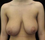 Breast Lift - Case 96 - Before