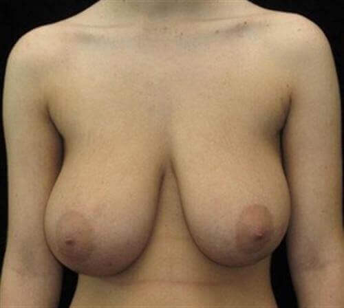 Breast Lift Patient Photo - Case 96 - before view-