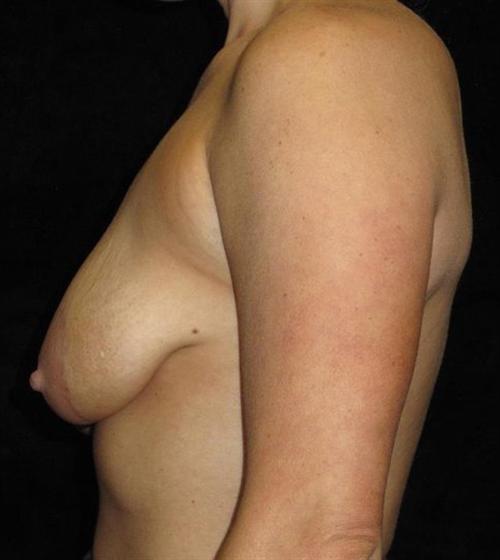 Breast Asymmetry Patient Photo - Case 138 - before view-2