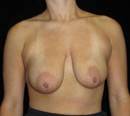 Breast Asymmetry Patient Photo - Case 138 - before view-