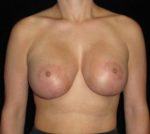 Breast Asymmetry - Case 138 - After