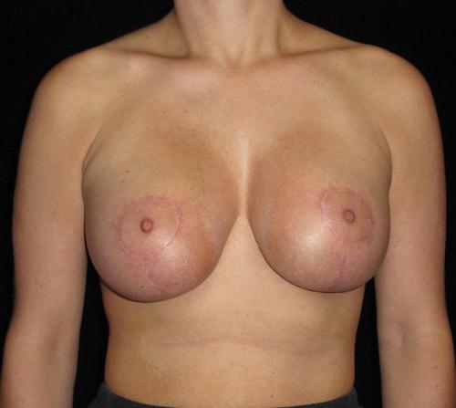 Breast Asymmetry Patient Photo - Case 138 - after view