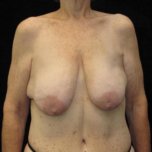 Breast lift with Augmentation Patient Photo - Case 102 - before view-1