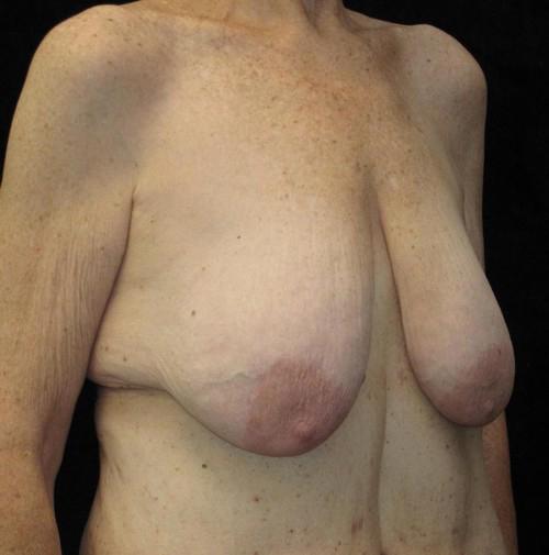 Breast lift with Augmentation Patient Photo - Case 102 - before view-