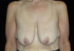 Breast Lift - Case 198 - Before