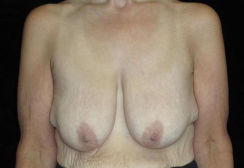 Breast Lift Patient Photo - Case 198 - before view-