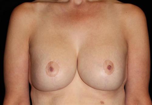 Breast Lift Patient Photo - Case 198 - after view