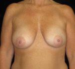 Breast Augmentation - Case 121 - Before