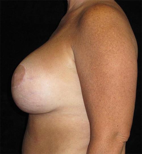 Breast Augmentation Patient Photo - Case 121 - after view-1