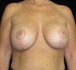 Breast Augmentation - Case 121 - After
