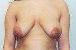 Breast Reduction - Case 157 - Before