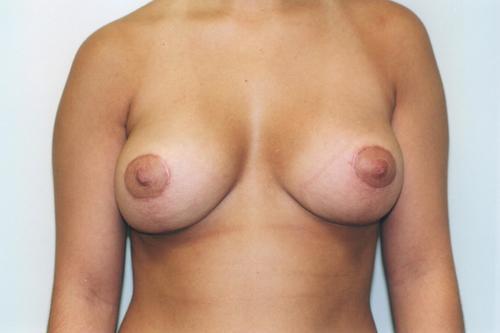 Breast Reduction Patient Photo - Case 157 - after view-0