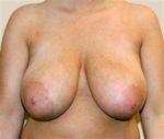 Breast Lift - Case 159 - Before