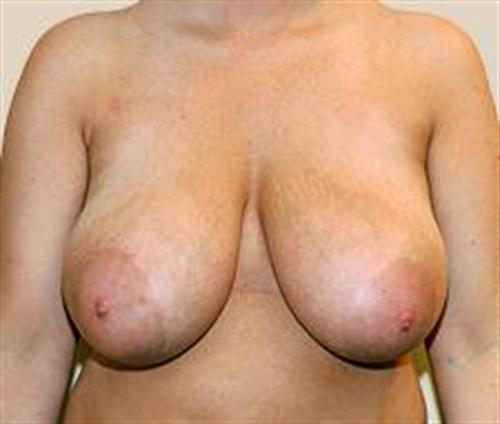 Breast Lift Patient Photo - Case 159 - before view-
