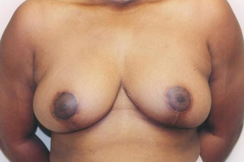 Breast Reduction Patient Photo - Case 156 - before view-