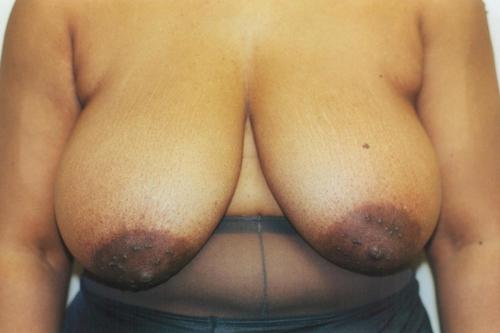 Breast Reduction Patient Photo - Case 156 - before view-