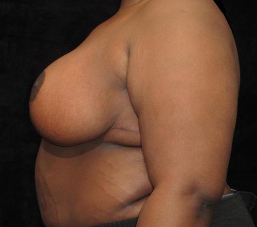 Breast Lift Patient Photo - Case 113 - after view-1