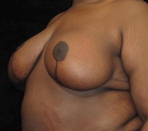 Breast Lift Patient Photo - Case 113 - after view-0