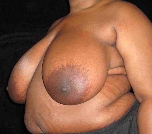 Breast Lift Patient Photo - Case 113 - before view-0