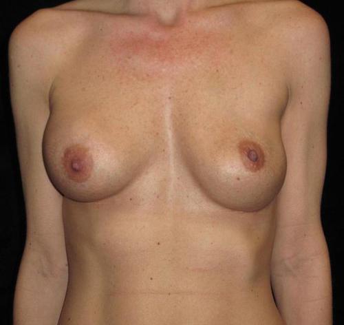 Breast Revision Patient Photo - Case 131 - before view-