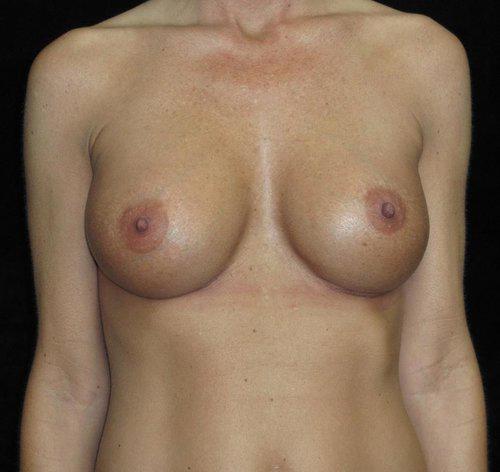 Breast Revision Patient Photo - Case 131 - after view