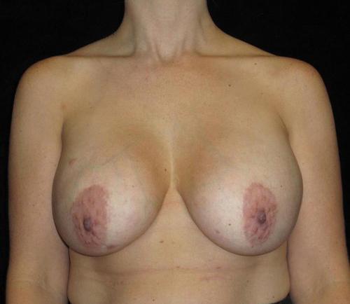 Breast Revision Patient Photo - Case 112 - before view-0
