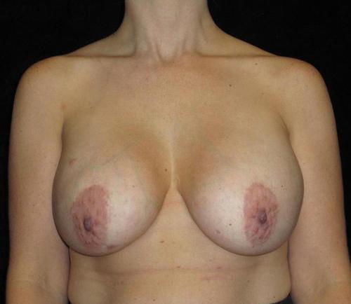 Breast Revision Patient Photo - Case 112 - before view-