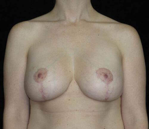 Breast Revision Patient Photo - Case 112 - after view