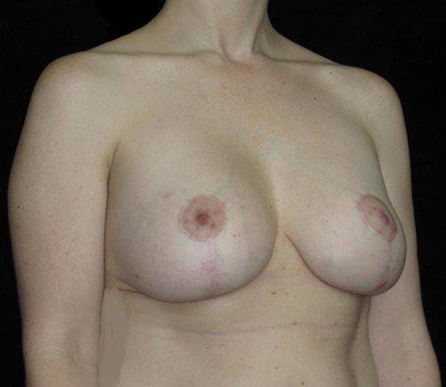 Breast Revision Patient Photo - Case 112 - after view-1