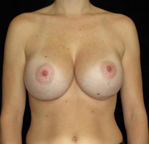 Breast Revision Patient Photo - Case 90 - after view