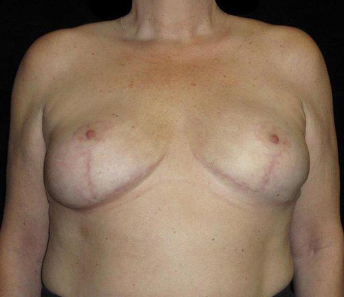 Breast Lift Patient Photo - Case 128 - after view