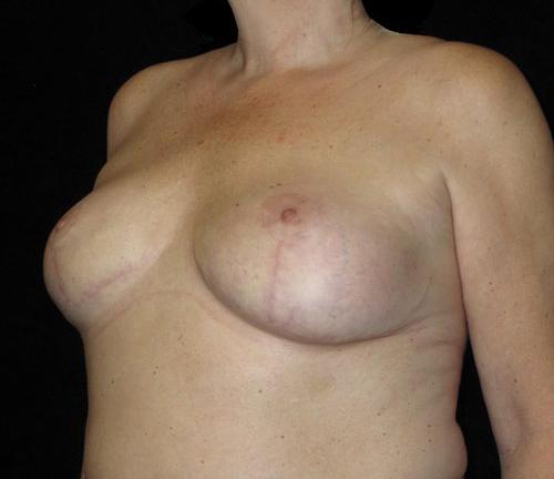 Breast Lift Patient Photo - Case 128 - after view-1