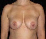 Breast Revision - Case 148 - After