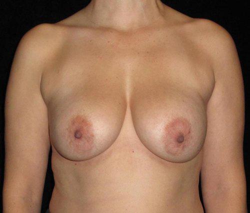 Breast Revision Patient Photo - Case 148 - after view