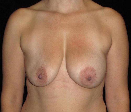 Breast Revision Patient Photo - Case 148 - before view-