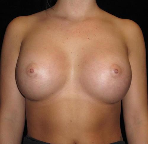 Breast Revision Patient Photo - Case 118 - after view