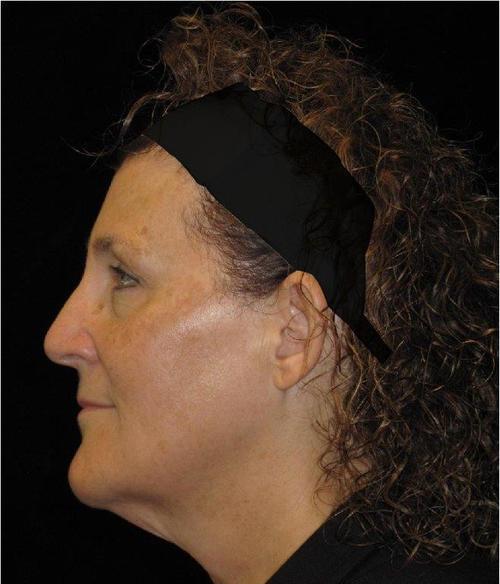 Facelift Patient Photo - Case 43 - before view-1