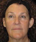 Facelift - Case 43 - Before