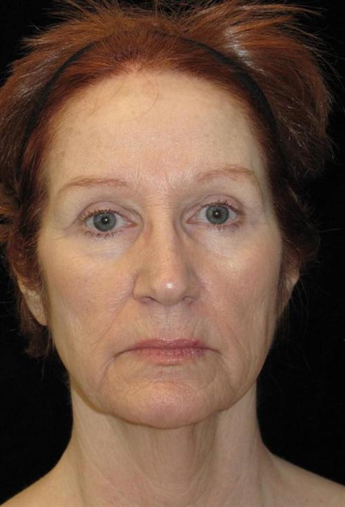 Eyelid Surgery Patient Photo - Case 48 - before view-