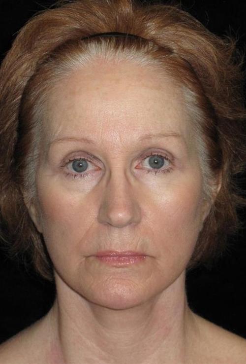 Eyelid Surgery Patient Photo - Case 48 - after view-0