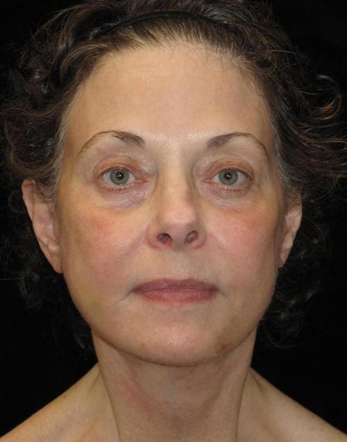 Facelift Patient Photo - Case 44 - after view